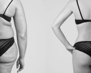 Vaser Liposuction Patient